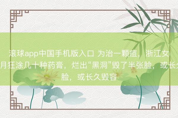 滚球app中国手机版入口 为治一颗痘，浙江女子2个月狂涂几十种药膏，烂出“黑洞”毁了半张脸，或长久毁容